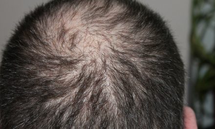 Comment éviter et traiter la perte de cheveux